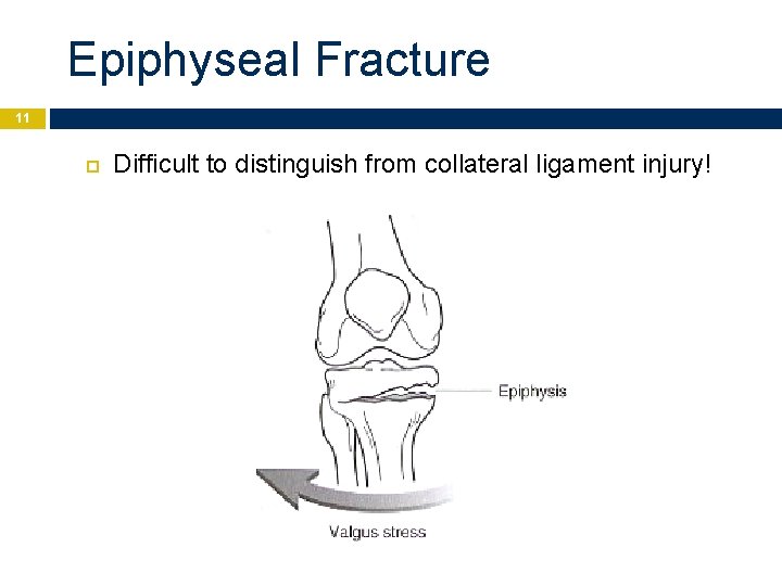 Epiphyseal Fracture 11 Difficult to distinguish from collateral ligament injury! 