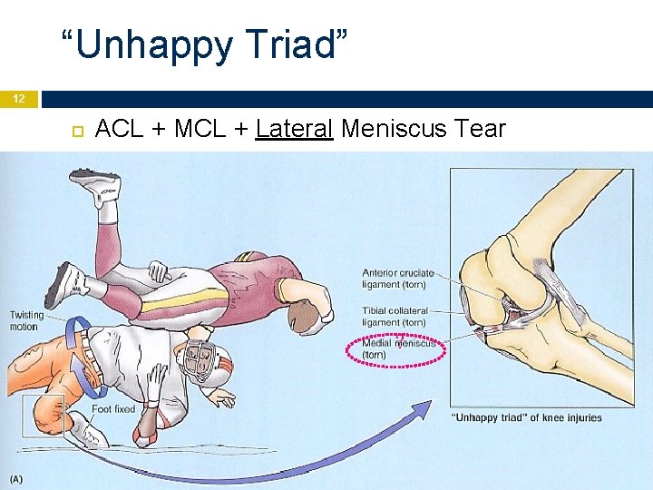 “Unhappy Triad” 12 ACL + MCL + Lateral Meniscus Tear ? 