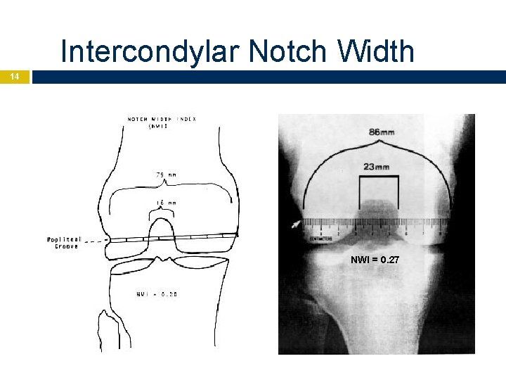 Intercondylar Notch Width 14 NWI = 0. 27 