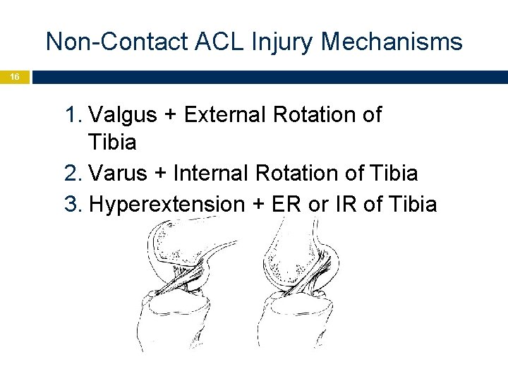 Non-Contact ACL Injury Mechanisms 16 1. Valgus + External Rotation of Tibia 2. Varus