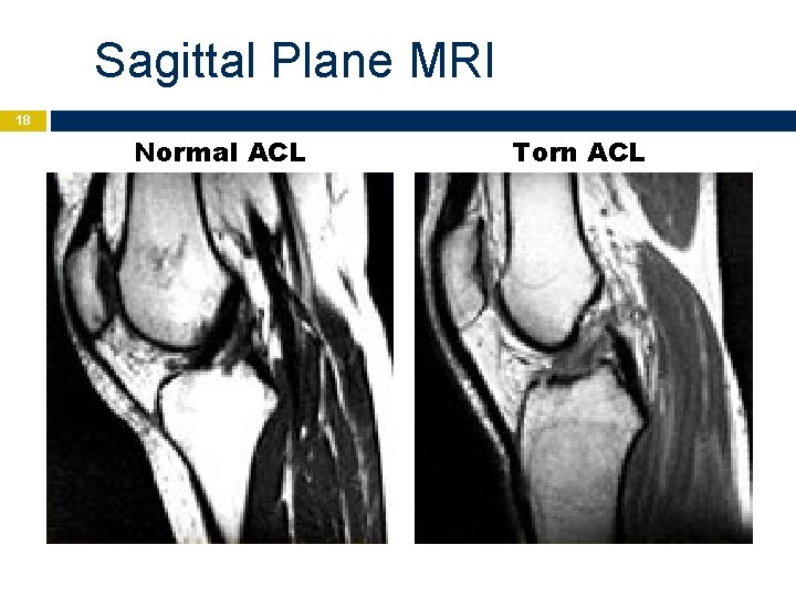 Sagittal Plane MRI 18 Normal ACL Torn ACL 