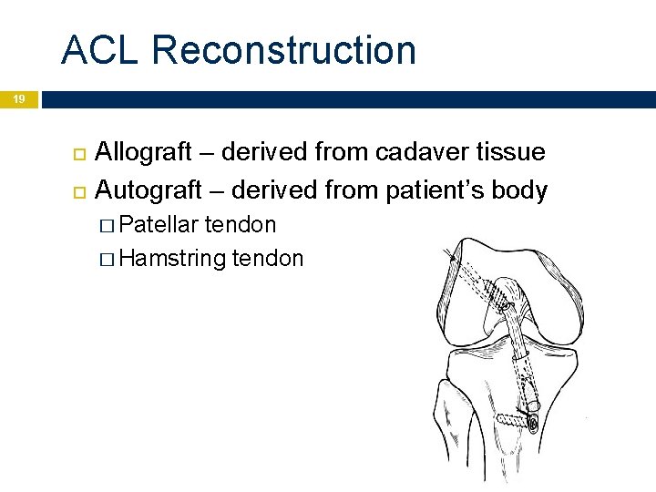 ACL Reconstruction 19 Allograft – derived from cadaver tissue Autograft – derived from patient’s