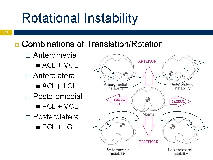 Rotational Instability 21 Combinations of Translation/Rotation � Anteromedial � ACL (+LCL) Posteromedial � ACL