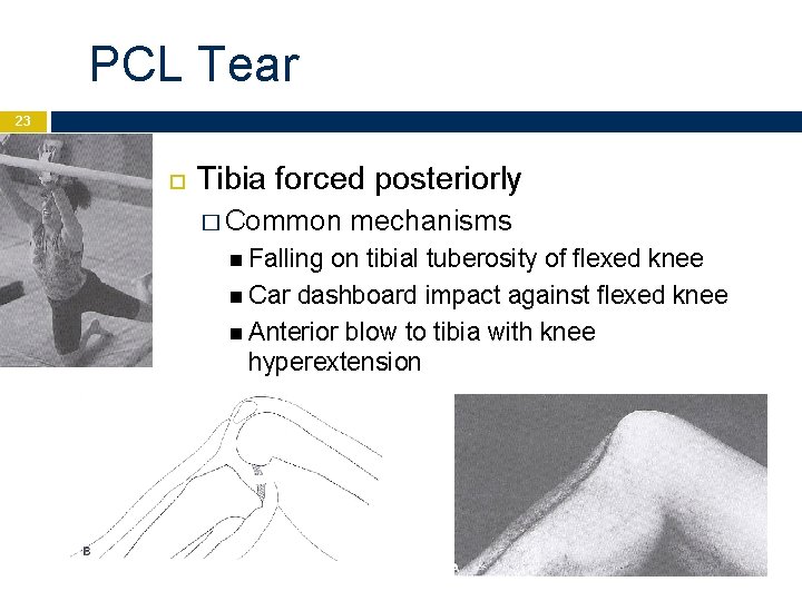 PCL Tear 23 Tibia forced posteriorly � Common Falling mechanisms on tibial tuberosity of