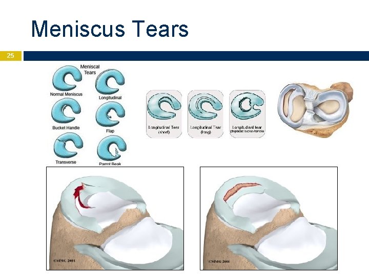 Meniscus Tears 25 