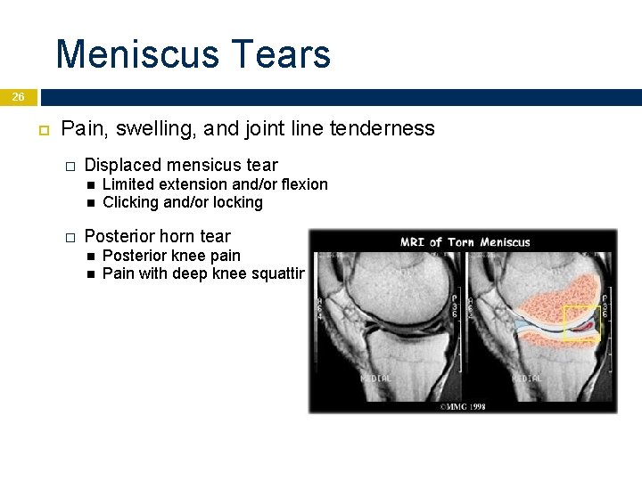 Meniscus Tears 26 Pain, swelling, and joint line tenderness � Displaced mensicus tear �