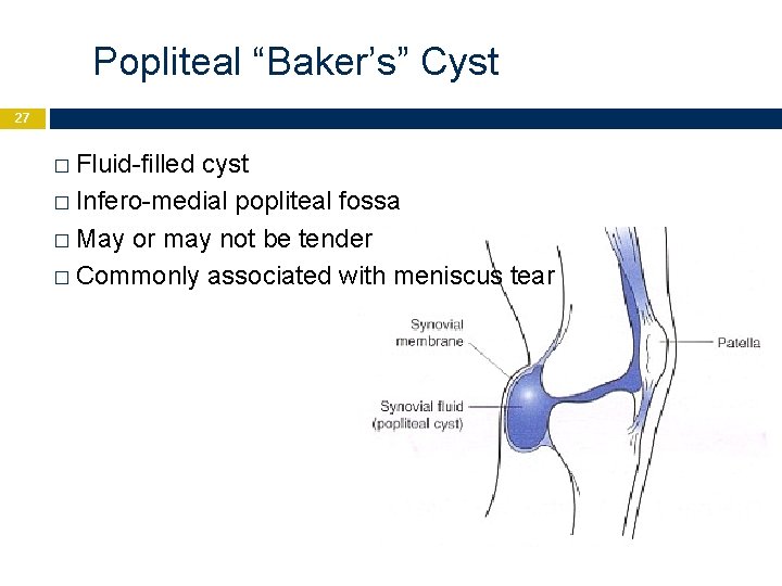 Popliteal “Baker’s” Cyst 27 � Fluid-filled cyst � Infero-medial popliteal fossa � May or