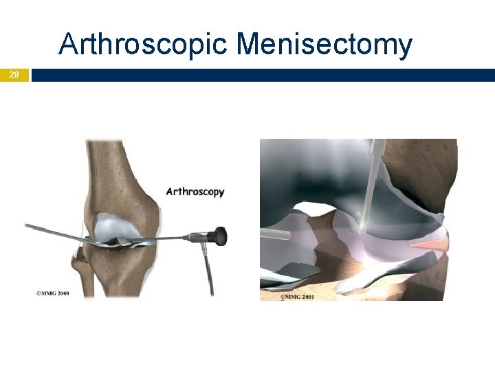 Arthroscopic Menisectomy 28 