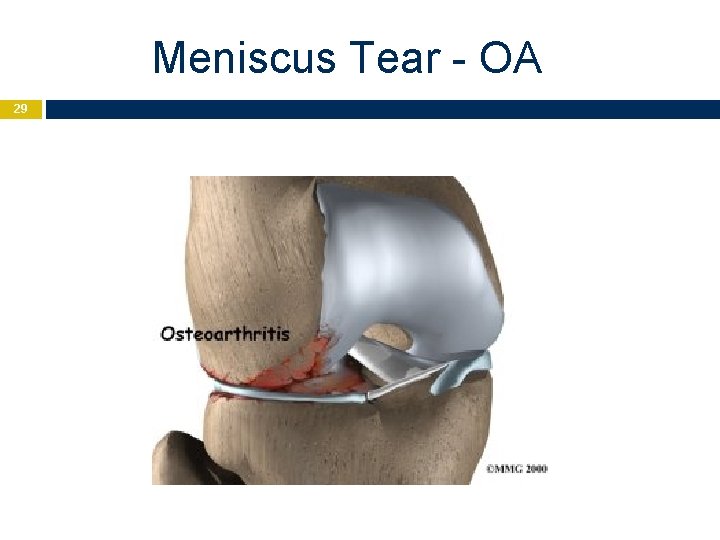 Meniscus Tear - OA 29 