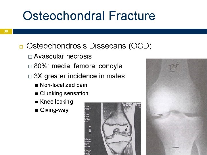 Osteochondral Fracture 30 Osteochondrosis Dissecans (OCD) � Avascular necrosis � 80%: medial femoral condyle