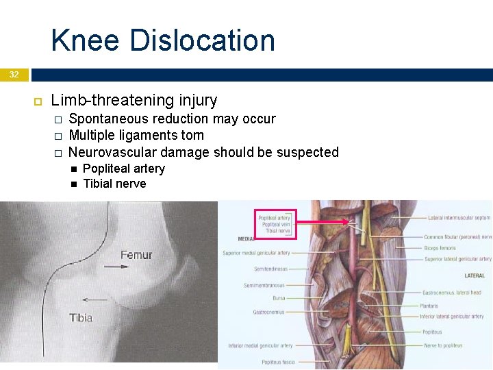 Knee Dislocation 32 Limb-threatening injury � � � Spontaneous reduction may occur Multiple ligaments