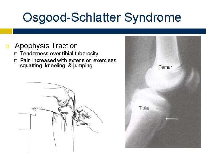 Osgood-Schlatter Syndrome Apophysis Traction � � Tenderness over tibial tuberosity Pain increased with extension