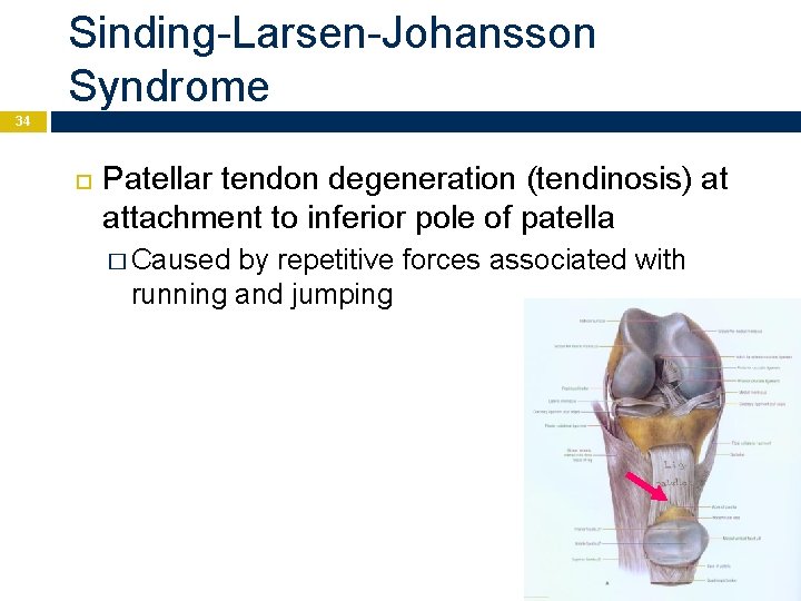 Sinding-Larsen-Johansson Syndrome 34 Patellar tendon degeneration (tendinosis) at attachment to inferior pole of patella
