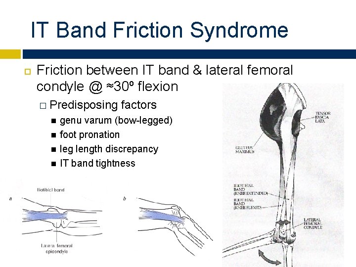 IT Band Friction Syndrome Friction between IT band & lateral femoral condyle @ ≈30º