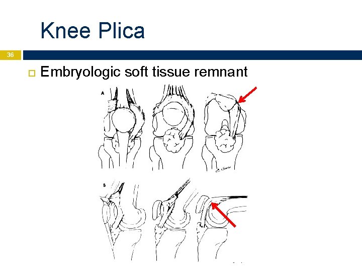 Knee Plica 36 Embryologic soft tissue remnant 