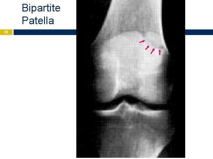 Bipartite Patella 38 