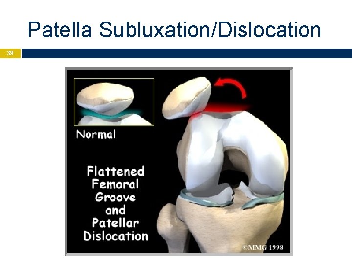 Patella Subluxation/Dislocation 39 