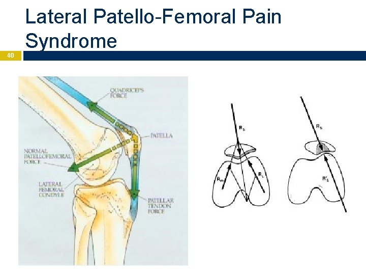 40 Lateral Patello-Femoral Pain Syndrome 