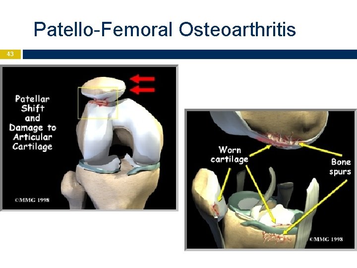 Patello-Femoral Osteoarthritis 43 