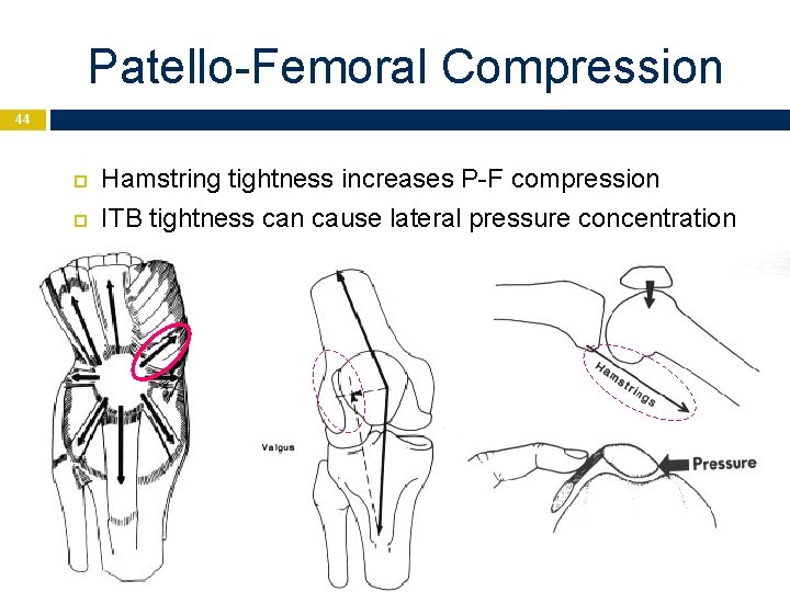 Patello-Femoral Compression 44 Hamstring tightness increases P-F compression ITB tightness can cause lateral pressure