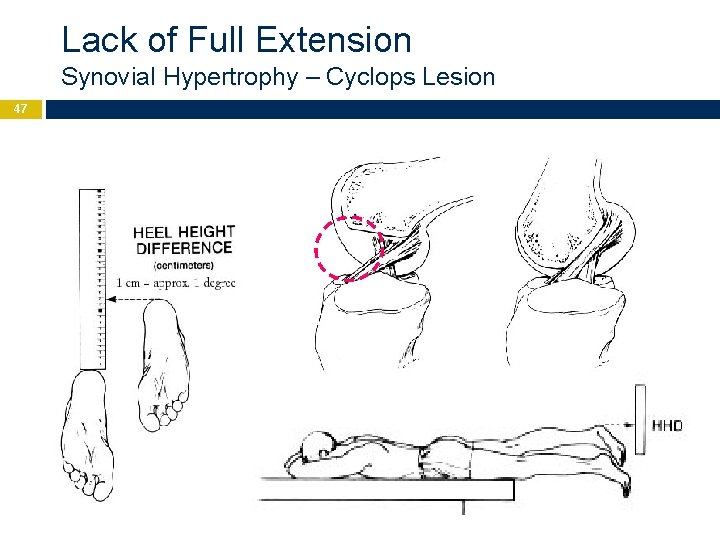 Lack of Full Extension Synovial Hypertrophy – Cyclops Lesion 47 