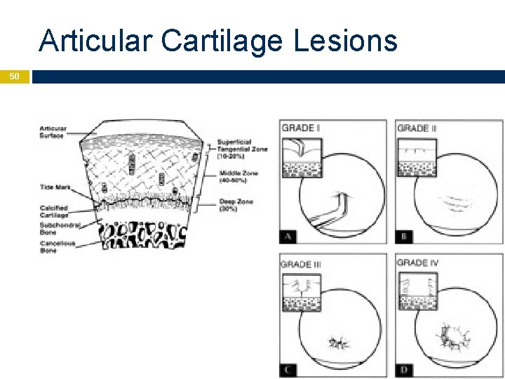 Articular Cartilage Lesions 50 