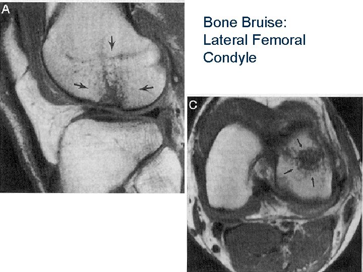 51 Bone Bruise: Lateral Femoral Condyle 