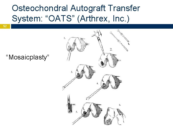 Osteochondral Autograft Transfer System: “OATS” (Arthrex, Inc. ) 52 “Mosaicplasty” 