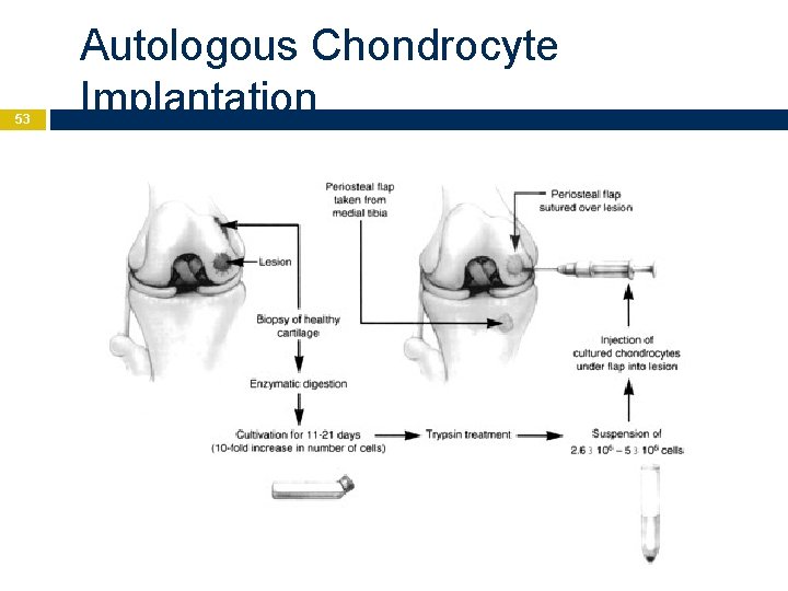 53 Autologous Chondrocyte Implantation 