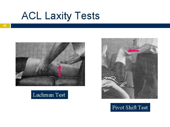 ACL Laxity Tests 60 Lachman Test Pivot Shift Test 