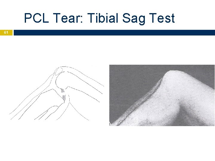 PCL Tear: Tibial Sag Test 61 