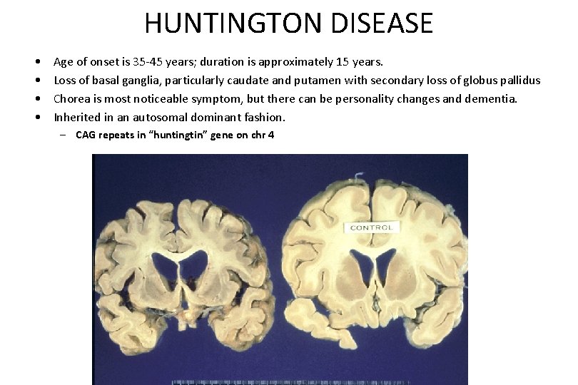 HUNTINGTON DISEASE • • Age of onset is 35 -45 years; duration is approximately