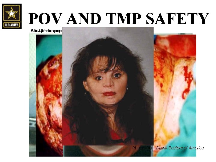 POV AND TMP SAFETY Her face moments after the accident… Today After 15 surgeries POV AND TMP SAFETY Her face moments after the accident… Today After 15 surgeries