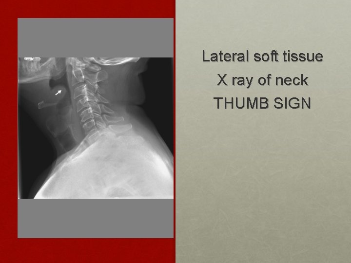 Lateral soft tissue X ray of neck THUMB SIGN 