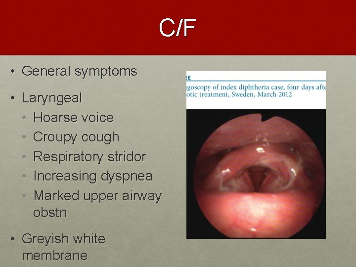 C/F • General symptoms • Laryngeal • Hoarse voice • Croupy cough • Respiratory