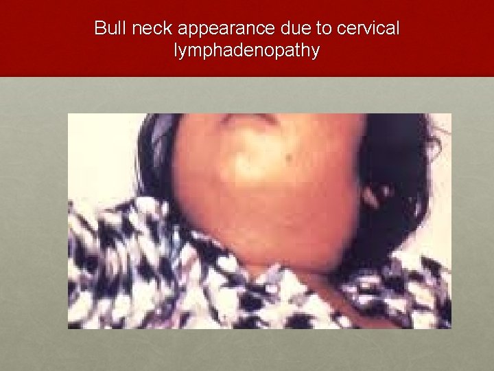 Bull neck appearance due to cervical lymphadenopathy 