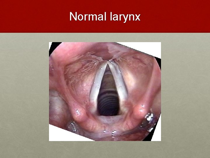 Normal larynx 