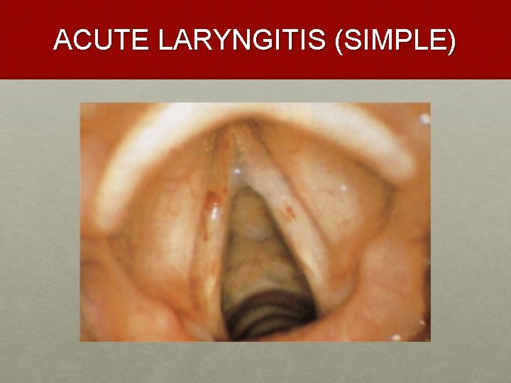 ACUTE LARYNGITIS (SIMPLE) 