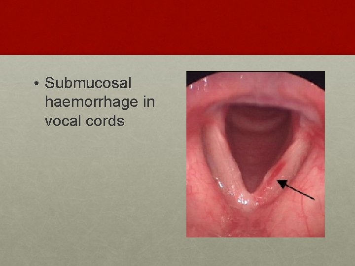  • Submucosal haemorrhage in vocal cords 