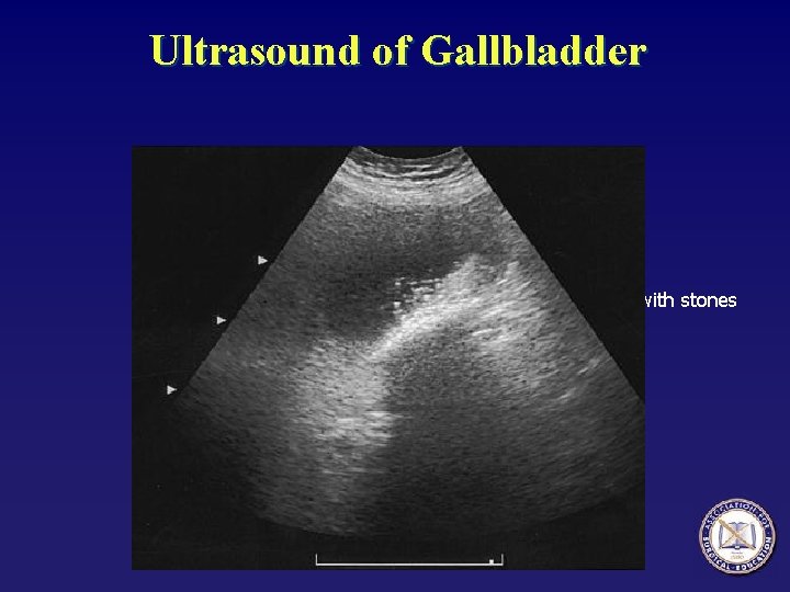 Ultrasound of Gallbladder with stones 