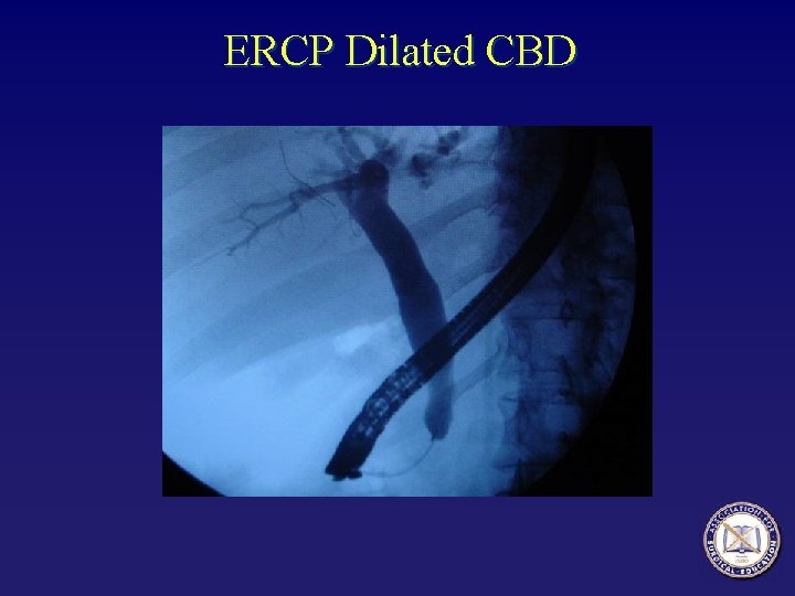 ERCP Dilated CBD 