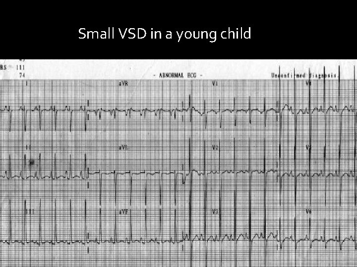 Small VSD in a young child 