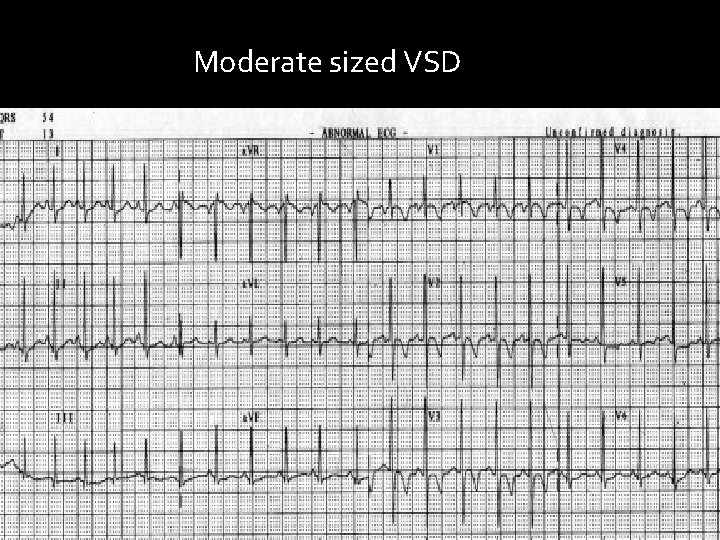 Moderate sized VSD 