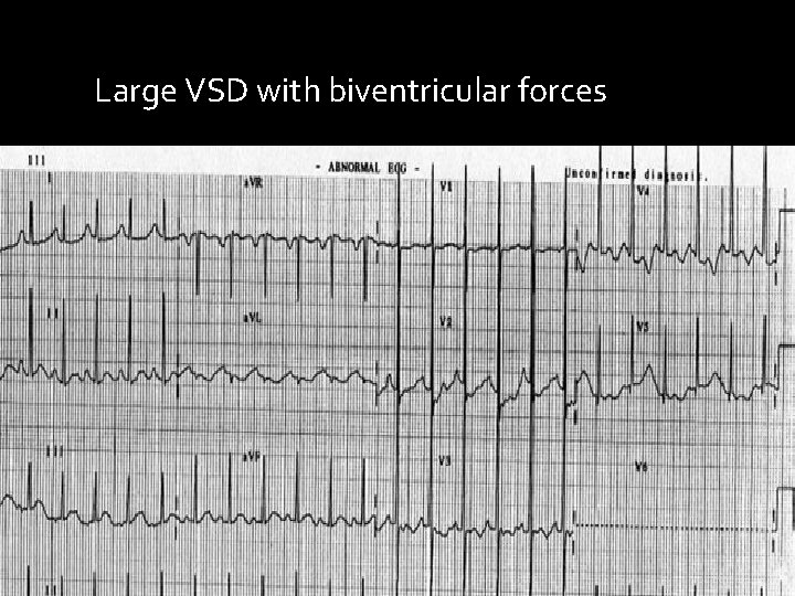 Large VSD with biventricular forces 