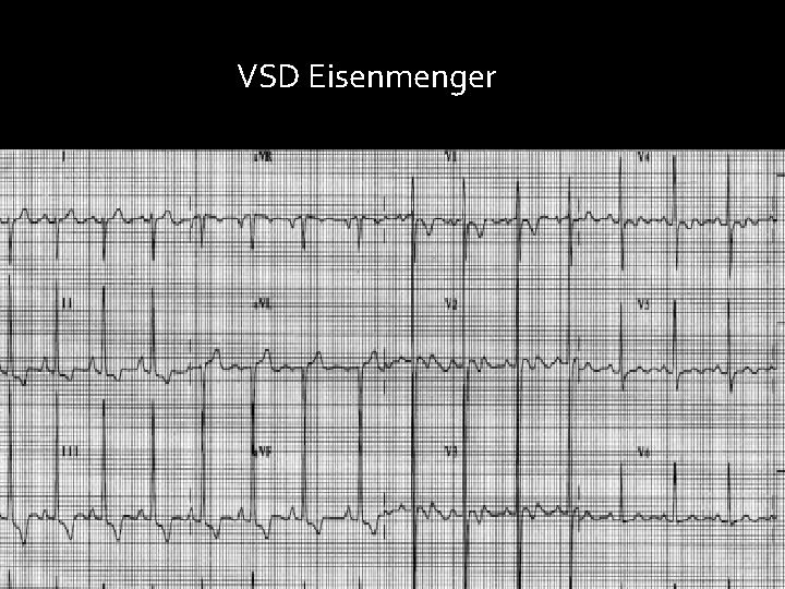 VSD Eisenmenger 