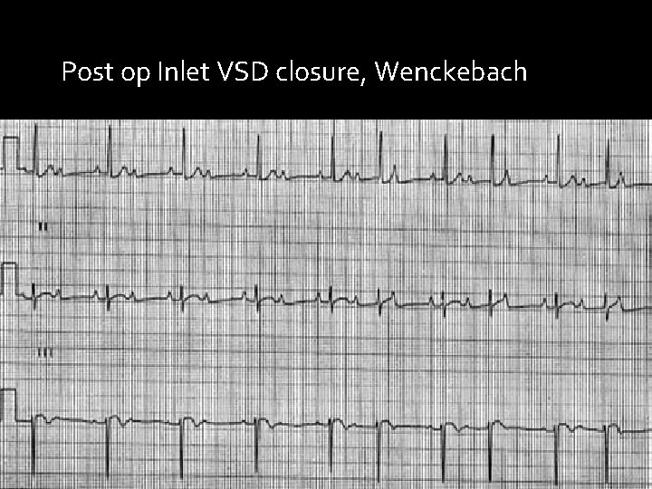 Post op Inlet VSD closure, Wenckebach 