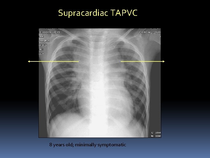 Supracardiac TAPVC Left vertical vein Dilated SVC 8 years old; minimally symptomatic 