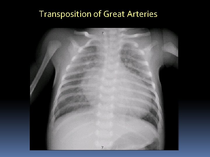 Transposition of Great Arteries 