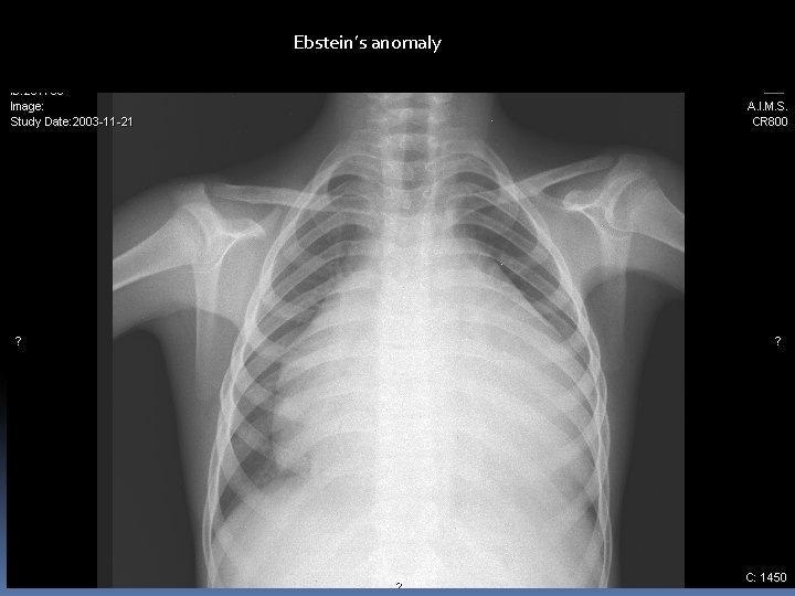 Ebstein’s anomaly 