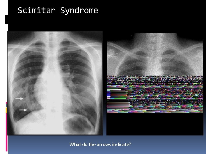 Scimitar Syndrome What do the arrows indicate? 